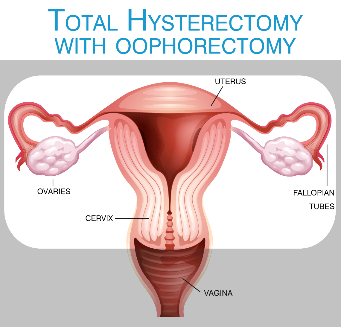 Do you know what a hysterectomy is? And – what it is NOT?