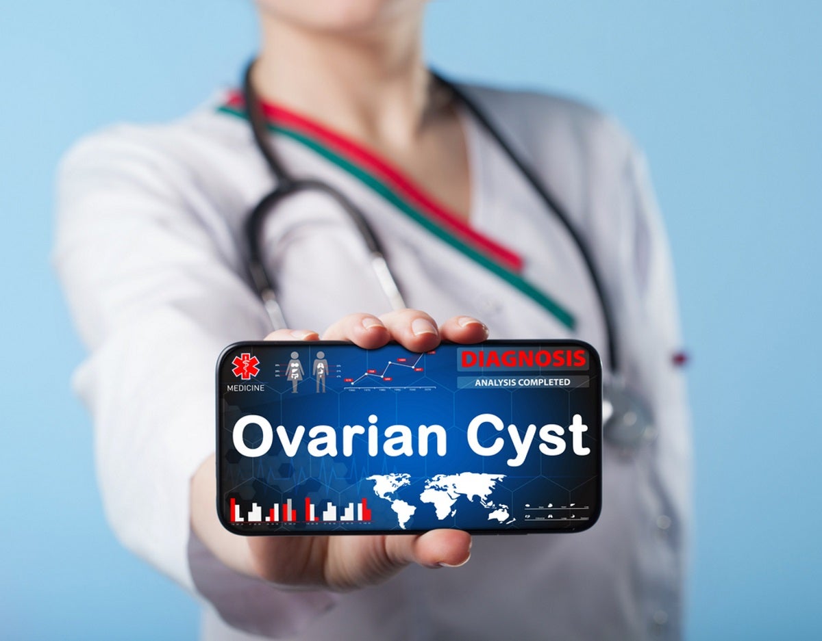 Everything You Should Know about the Super-Common Ovarian Cyst