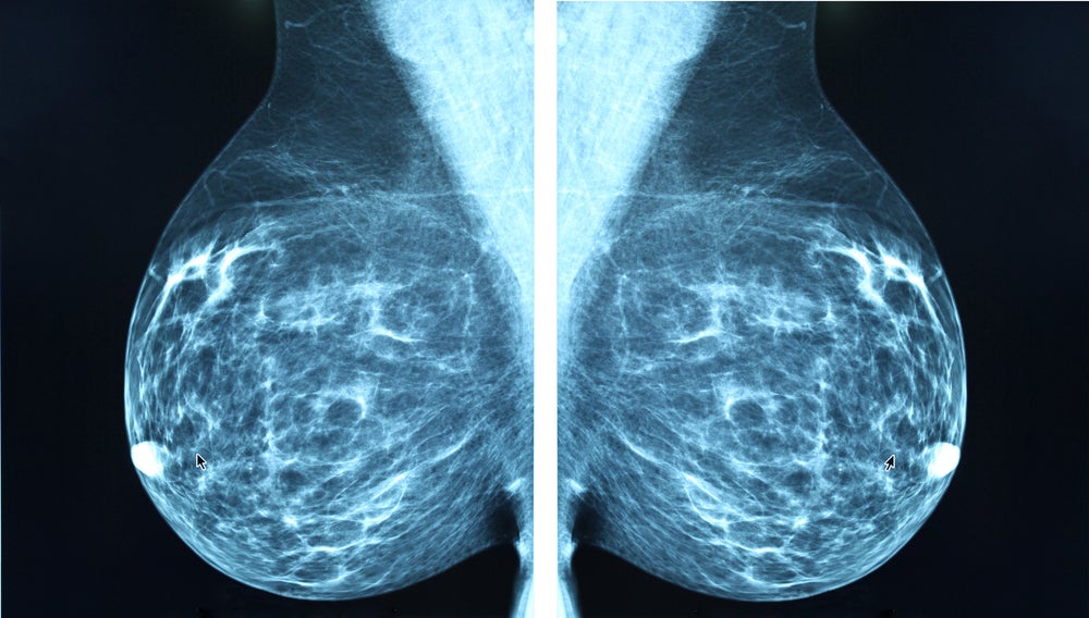 New approach for hard-to-treat BRCA breast cancer shrinks tumours twice as fast