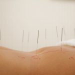woman with acupuncture needles in abdomen