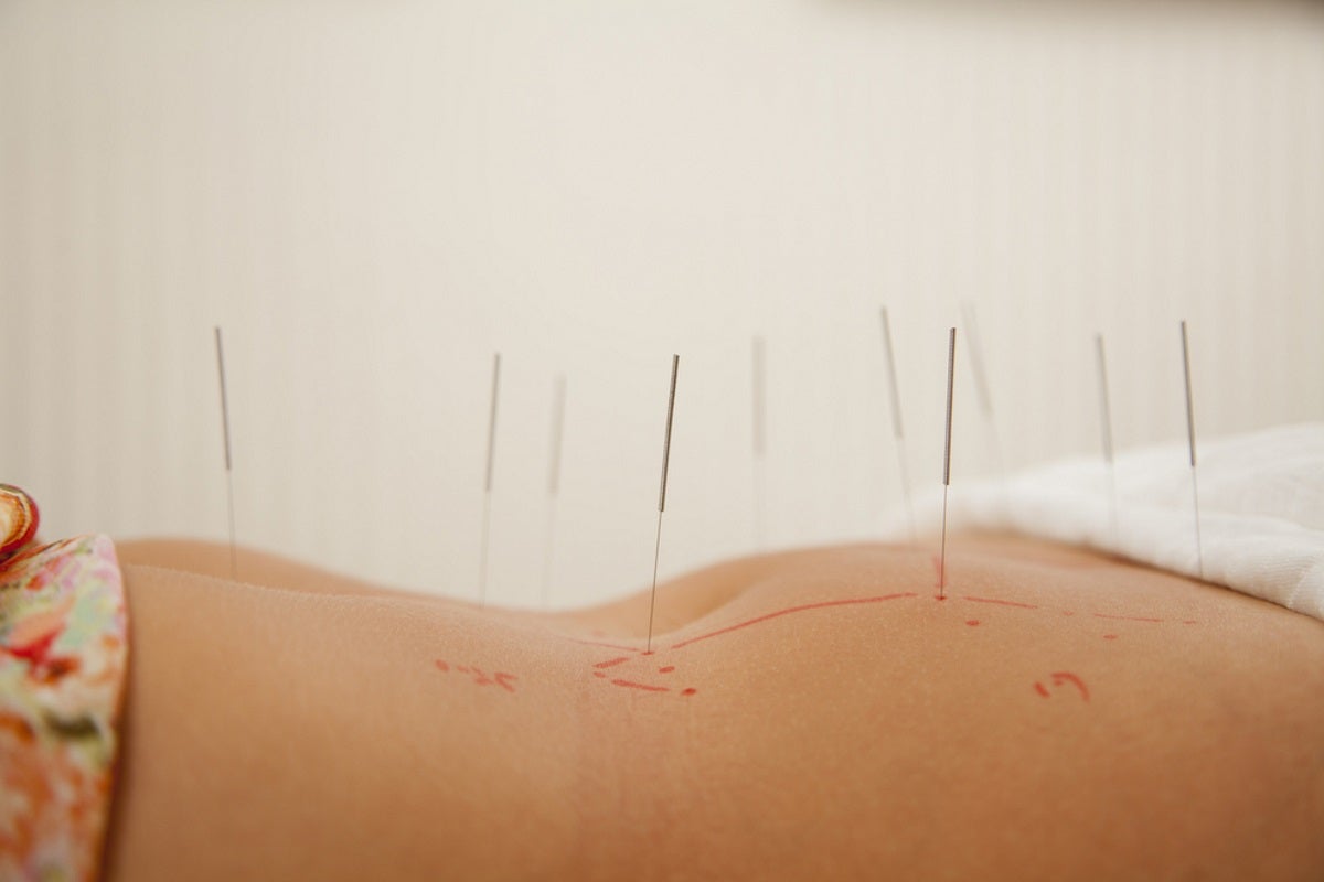 Acupuncture for Endometriosis and Pelvic Pain